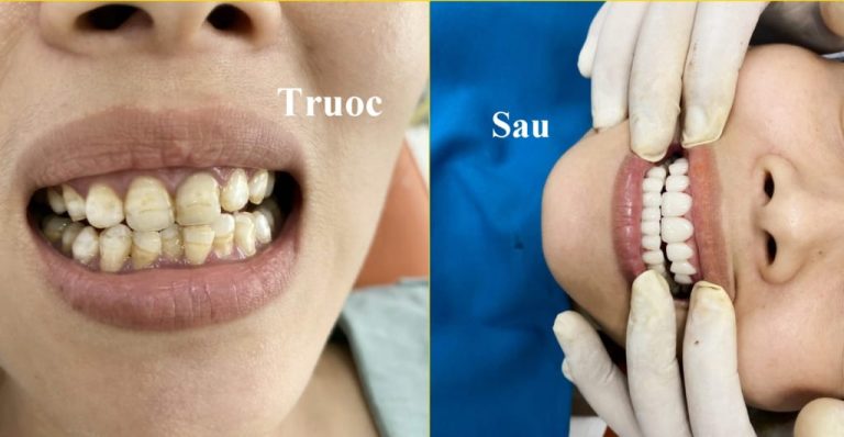 Trước và sau khi bọc răng sứ tại Nha khoa Đồng Xoài Trước và sau khi bọc răng sứ tại Nha khoa Đồng Xoài