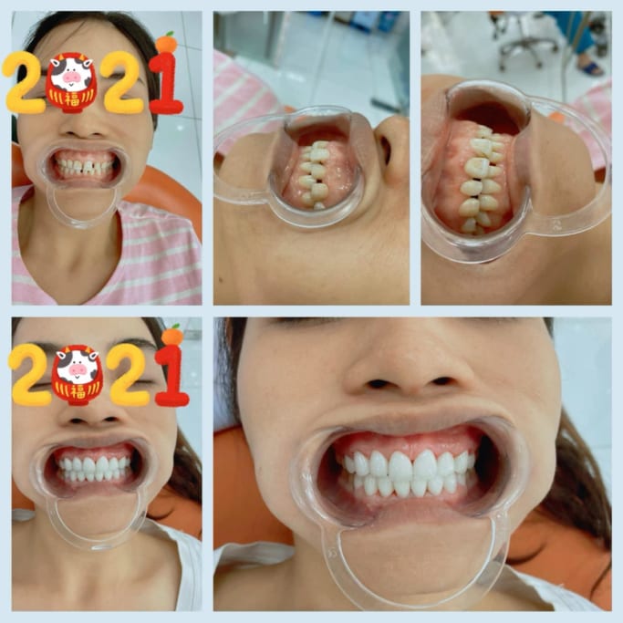 Trước và sau khi bọc răng sứ cho trẻ tại Nha khoa Đồng Xoài Trước và sau khi bọc răng sứ cho trẻ tại Nha khoa Đồng Xoài