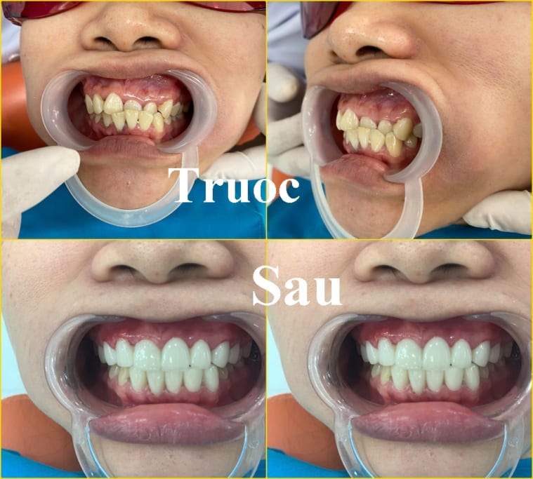 Trước và sau khi bọc răng sứ cho người lớn tại Nha khoa Đồng Xoài Trước và sau khi bọc răng sứ cho người lớn tại Nha khoa Đồng Xoài