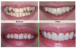 Phục hình răng cố định