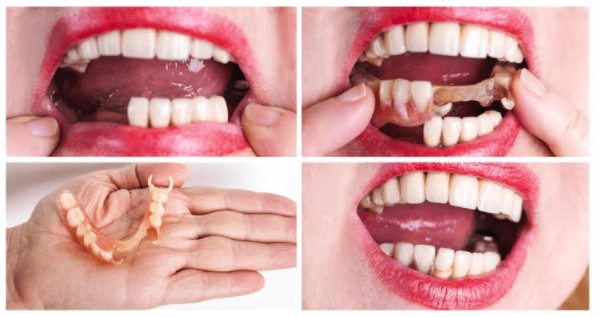Phục hình răng tháo lắp