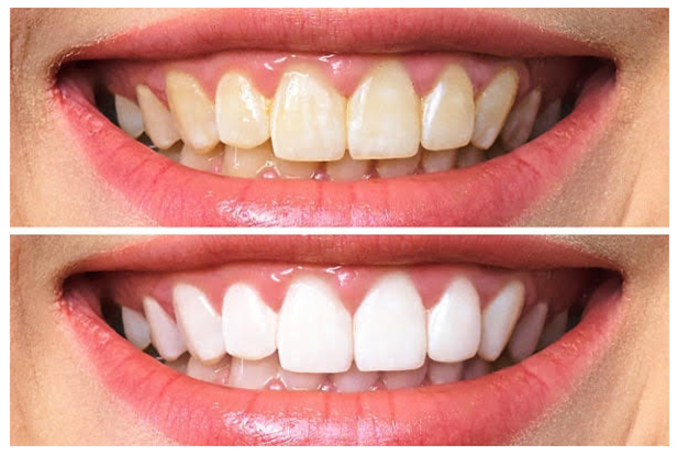 Tẩy trắng răng Bình Dương uy tín an toàn nhanh chóng Tẩy trắng răng Bình Dương uy tín an toàn nhanh chóng