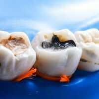 Điều trị tuỷ (Nội Nha)