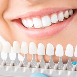 Phục hình răng tháo lắp