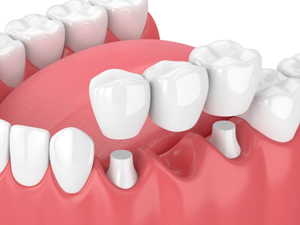 Phục hình cố định nhằm cải thiện tính thẩm mỹ răng hàm mặt
