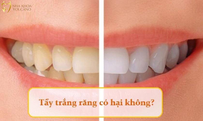 Liệu tẩy trắng răng có gây hại không? Liệu tẩy trắng răng có gây hại không?