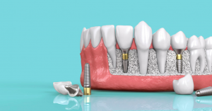 Trồng răng implant có tốt không?