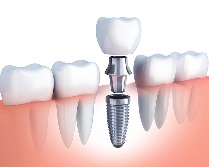 Trồng răng implant có nguy hiểm không? Trồng răng implant có nguy hiểm không?