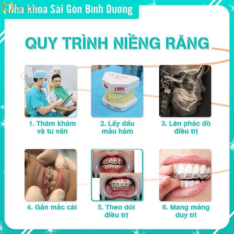 Quy trình niềng răng tại Nha khoa Sài Gòn Bình Dương với khí cụ chất lượng Quy trình niềng răng tại Nha khoa Sài Gòn Bình Dương với khí cụ chất lượng