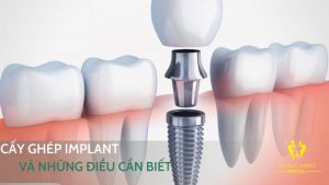 tieu chi chon dia chi trong implant o binh duong