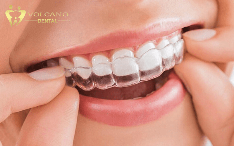 Niềng răng mắc cài trong suốt