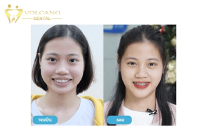Niềng răng là gì? Bảng giá niềng răng trả góp Bình Dương tại Đồng