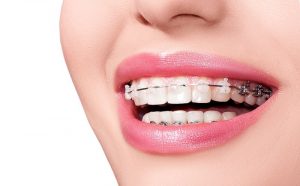 Top 13 địa chỉ niềng răng Bình Dương uy tín, tốt nhất hiện nay