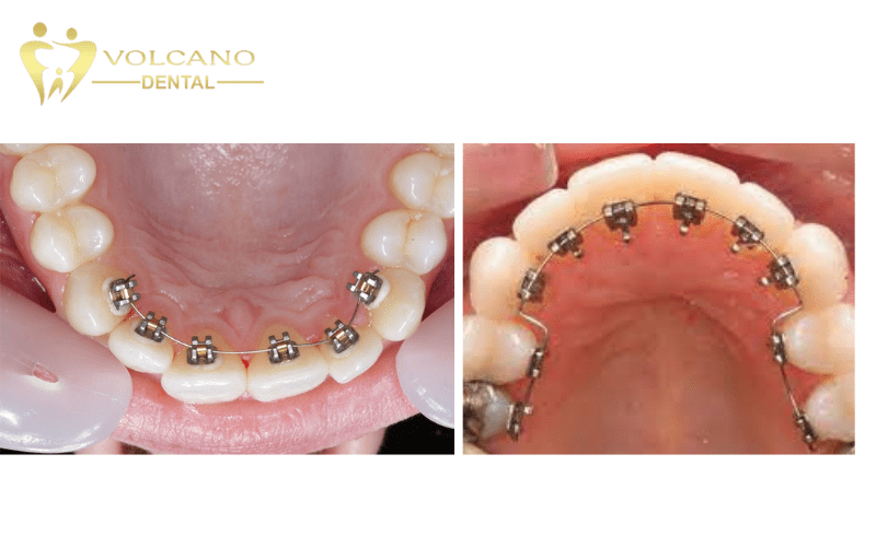 Niềng răng mắc cài mặt trong