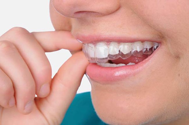 Niềng răng Invisalign Niềng răng Invisalign