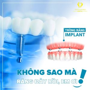 Bảng giá trồng răng implant ở Bình Dương 2024