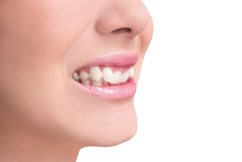 Khớp cắn sâu Khớp cắn sâu