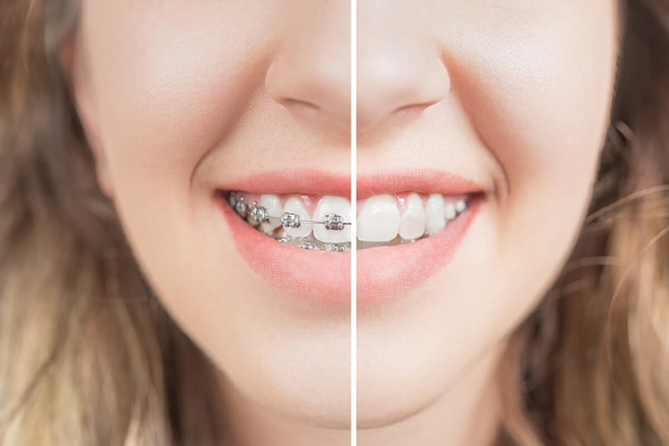 Lợi ích của chỉnh nha mang lại Lợi ích tuyệt vời của chỉnh nha mang lại