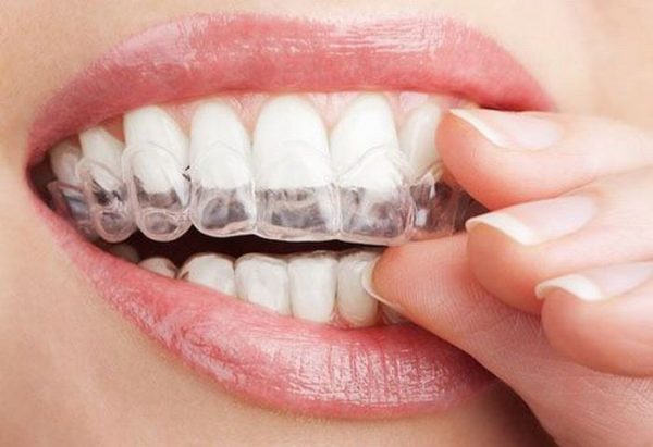 Nắn chỉnh răng bằng invisalign Nắn chỉnh răng bằng invisalign