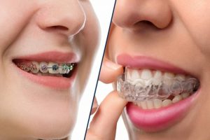 Chỉnh nha là gì? Phương pháp chỉnh nha phổ biến nhất hiện nay
