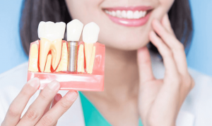 Trồng răng sứ là gì? Bảng giá trồng răng sứ mới nhất?