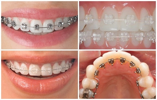 Giá cả của các loại niềng răng phổ biến hiện nay Giá cả của các loại niềng răng phổ biến hiện nay