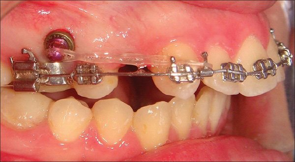 Niềng răng có đau không? Địa chỉ niềng răng uy tín ở Bình Dương Niềng răng có đau không? Địa chỉ niềng răng uy tín ở Bình Dương