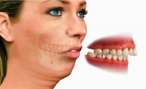 Niềng răng hô, móm ở Bình Dương - Giải pháp hoàn hảo cho diện mạo tự tin