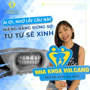 Quy trình niềng răng hô, móm ở Bình Dương chuẩn y khoa