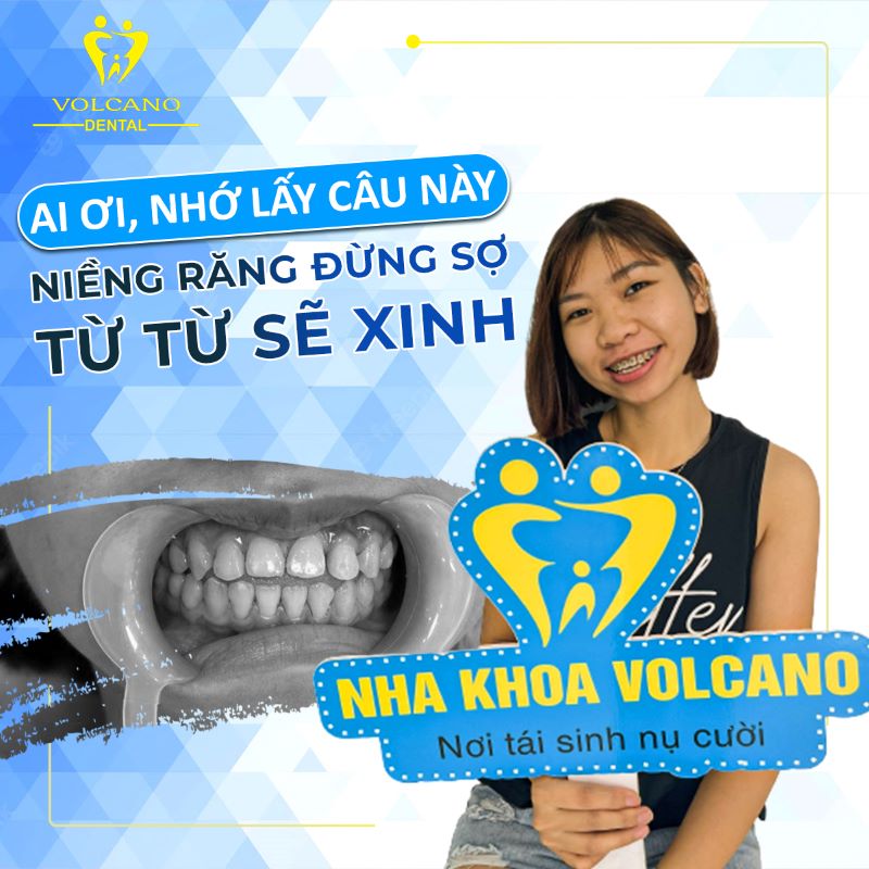 Địa chỉ niềng răng trẻ em ở Bình Dương uy tín, giá tốt nhất