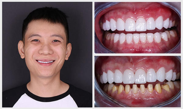 Tùy vào tình trạng răng mà các loại răng sứ được tư vấn phù hợp nhất Tùy vào tình trạng răng mà các loại răng sứ được tư vấn phù hợp nhất