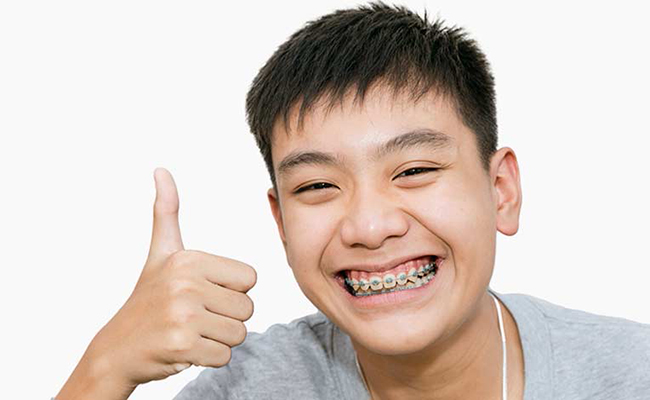 Địa chỉ niềng răng trẻ em ở Bình Dương uy tín, giá tốt nhất