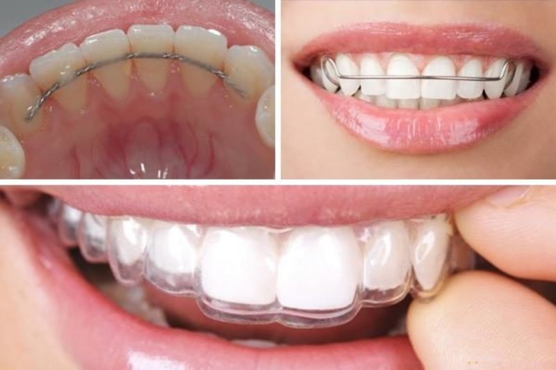 Giá niềng răng ở Bình Dương đắt không? Chi phí niềng răng bao nhiêu