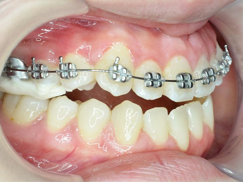 Giá niềng răng ở Bình Dương đắt không? Chi phí niềng răng bao nhiêu