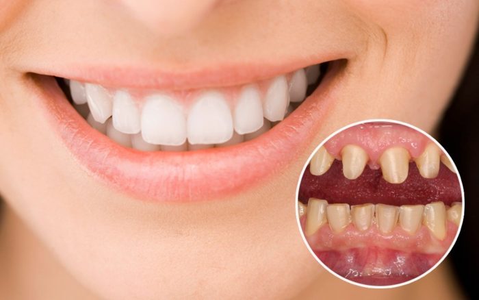Trồng răng sứ là gì? Trồng răng sứ là gì?