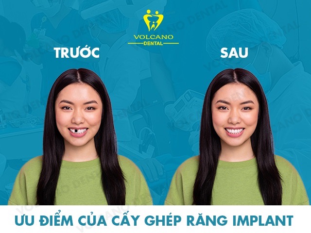 truoc va sau khi cay impant