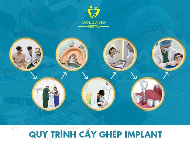 quy trinh cay imlpant 