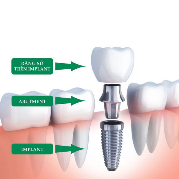 Cấu tạo răng Implant gồm 3 phần chính