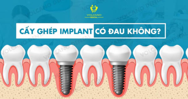 Làm răng Implant có đau không? Đây là nỗi sợ của nhiều người