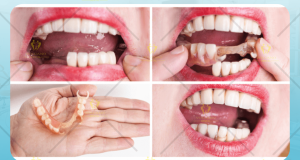 Phục hình tháo lắp
