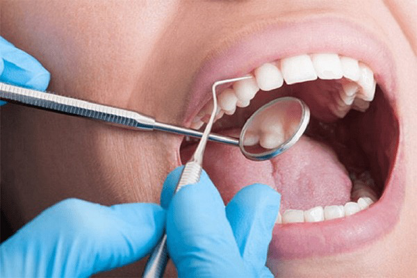 Cạo vôi răng giúp lấy sạch mảng bám trên răng Cạo vôi răng giúp lấy sạch mảng bám trên răng