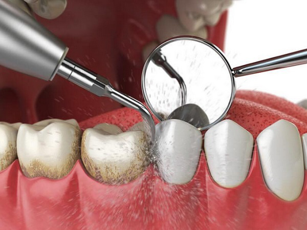 Lấy cao răng giúp hàm răng sạch sẽ và sáng bóng Lấy cao răng giúp hàm răng sạch sẽ và sáng bóng