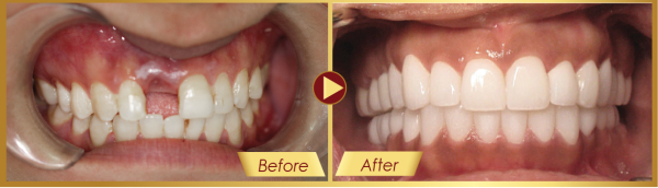 Hình ảnh khách trước và sau khi cấy ghép Implant