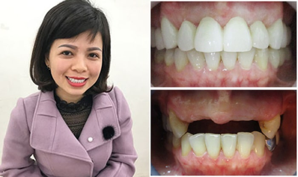 Hình ảnh trước và sau khi cấy ghép Implant