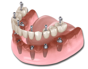 Biến chứng khi trồng răng Implant