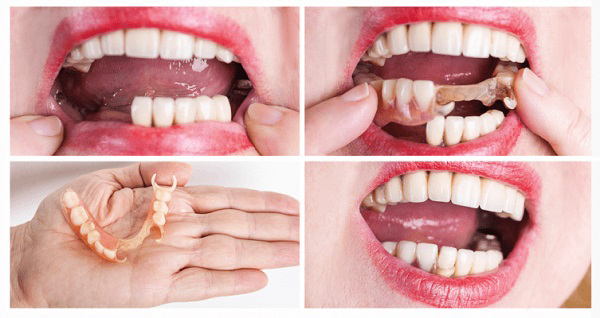 Phục hình tháo lắp có tốt không? Phục hình tháo lắp có tốt không?