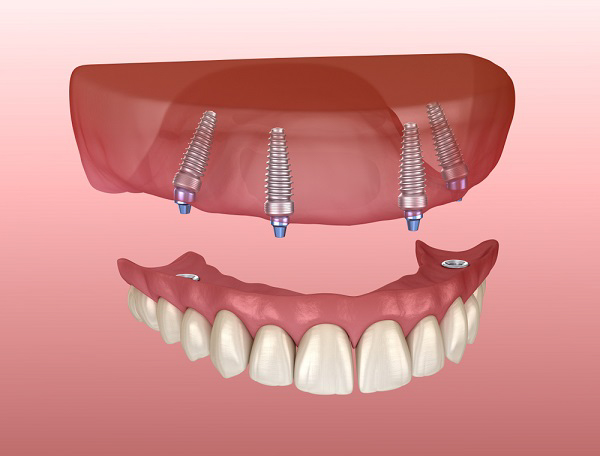 Phục hình tháo lắp giúp cải thiện tình trạng răng miệng Phục hình tháo lắp giúp cải thiện tình trạng răng miệng