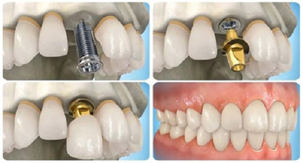 Thời gian tháo lắp hàm kéo dài từ 3 – 14 ngày Thời gian tháo lắp hàm kéo dài từ 3 – 14 ngày