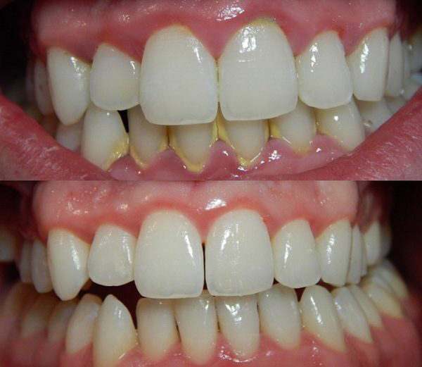 Có thể phẫu thuật để điều trị nha chu Có thể phẫu thuật để điều trị nha chu