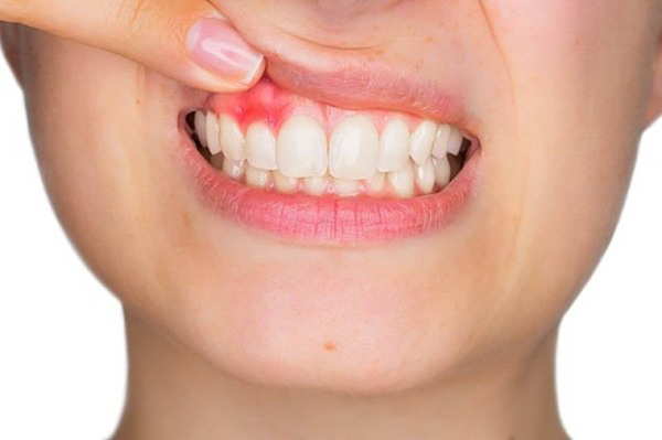 Tìm hiểu về các thủ thuật tái tạo trong điều trị nha chu Tìm hiểu về các thủ thuật tái tạo trong điều trị nha chu